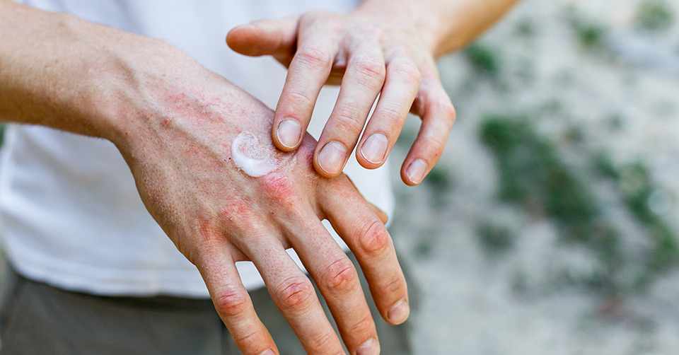 do-you-have-dry-skin-on-your-hands-here-are-some-quick-methods-for